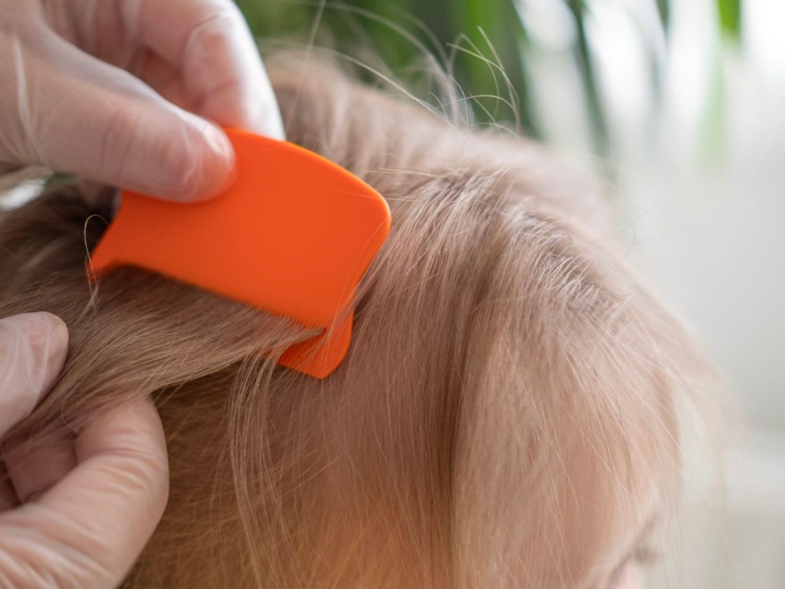 Los piojos, un problema prevenible muy común en edad escolar