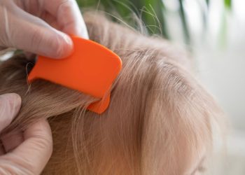 Los piojos, un problema prevenible muy común en edad escolar